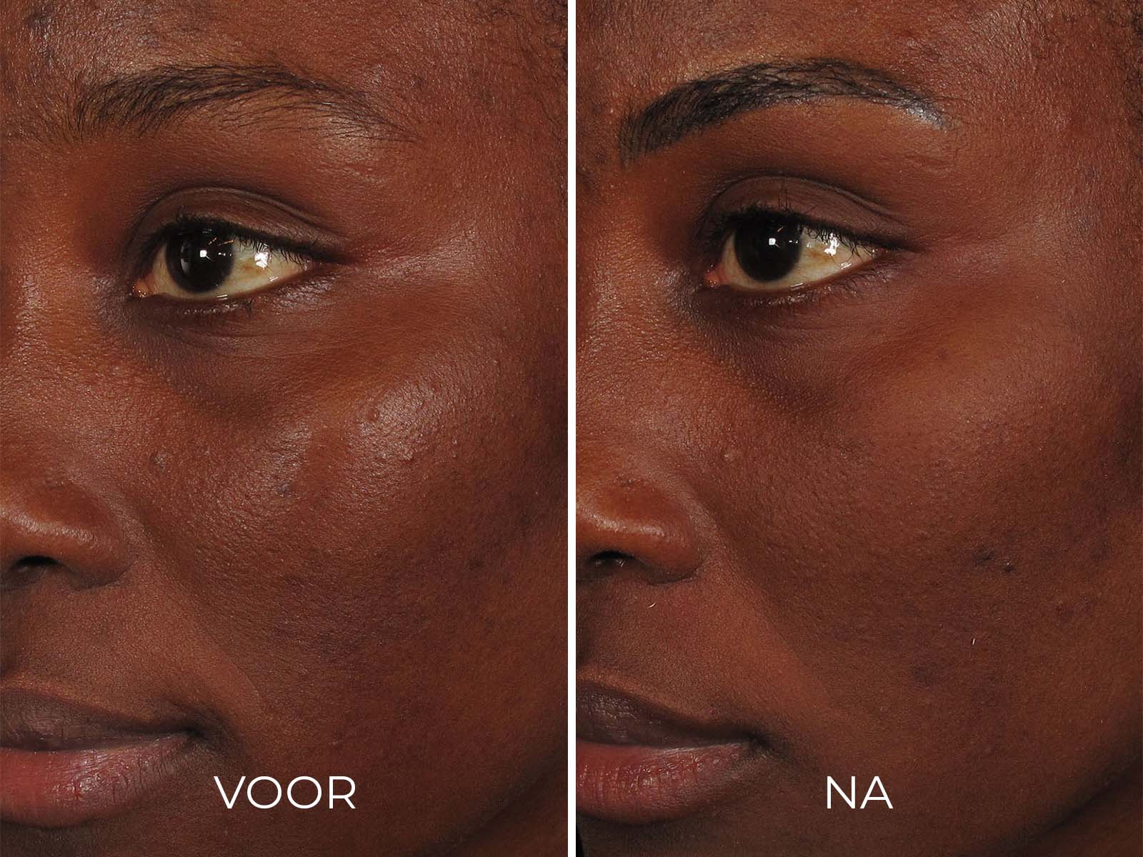 ILUMA - Intense Facial Illuminator